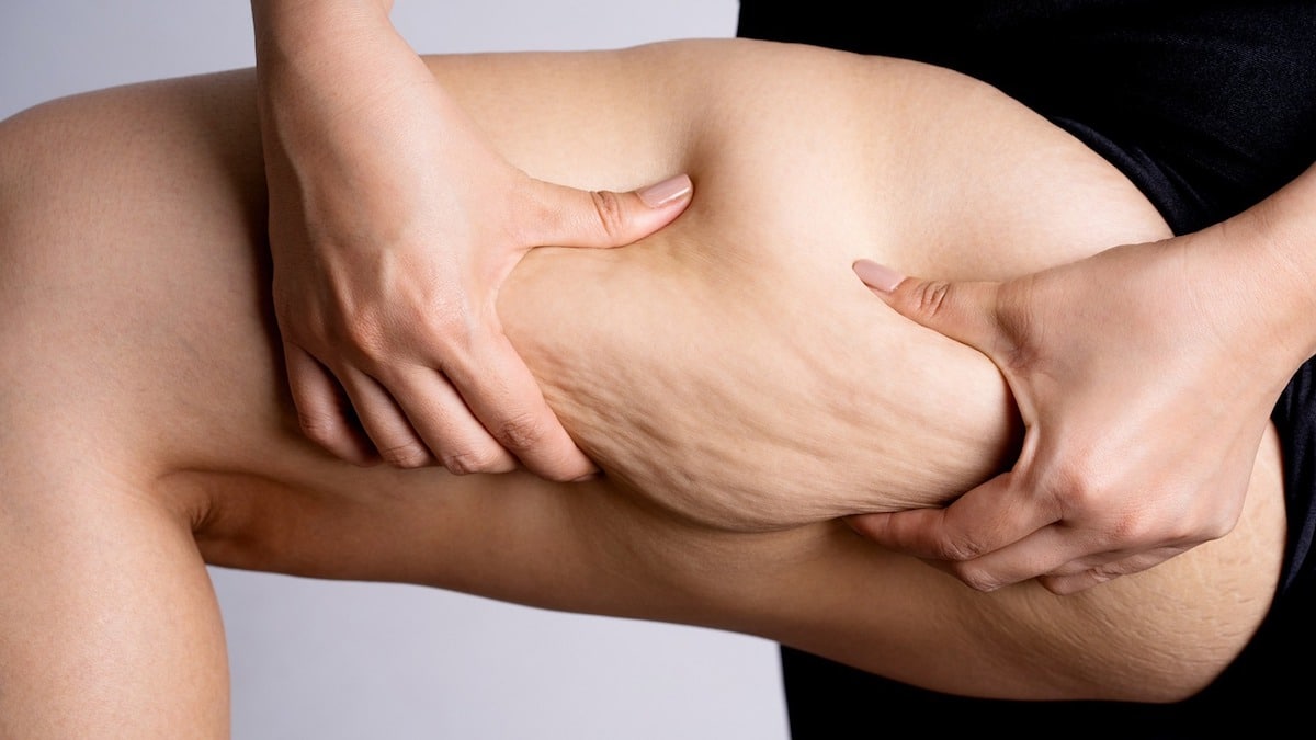 Qu'est-ce que la peau d'orange ? Tout ce que vous devez savoir sur la cellulite