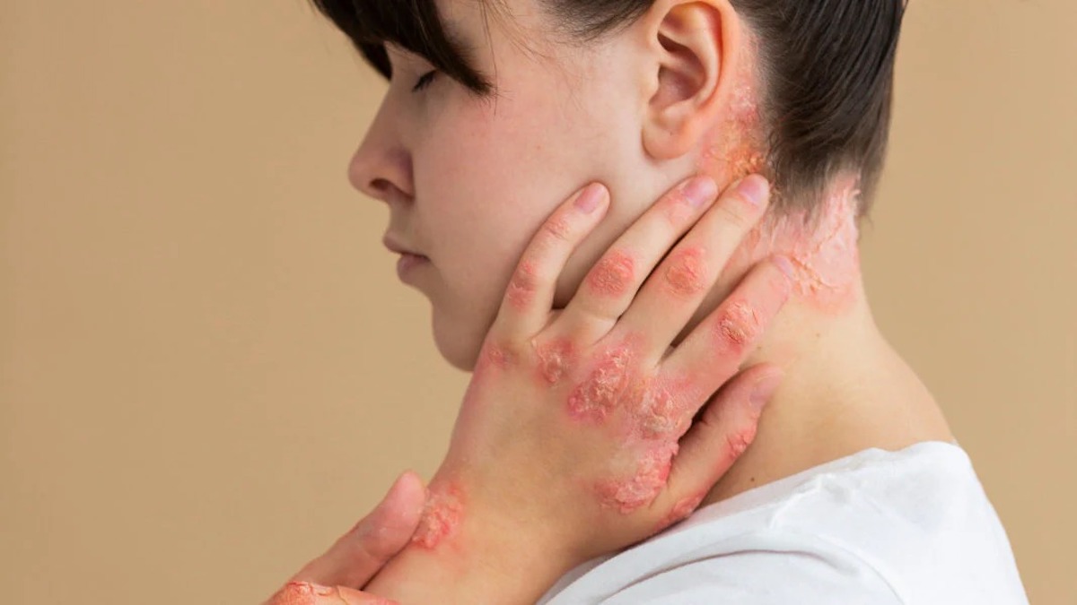 Qu’est-ce que le psoriasis cutané ? La réponse d'un dermatologue