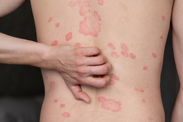 Qu’est-ce que le psoriasis cutané ? La réponse d'un dermatologue