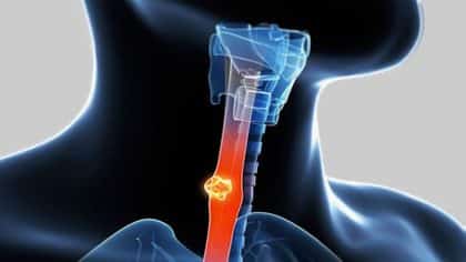 Reflux acide : est-ce mortel ?