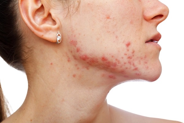 Rosacée : symptômes et causes