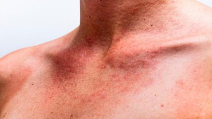Rosacée : symptômes et causes