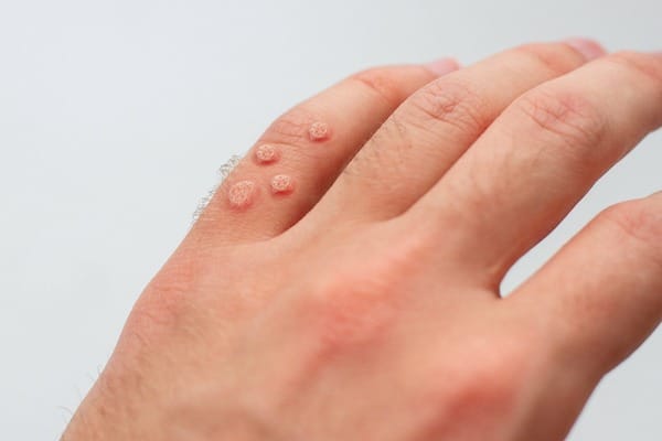 Signes du virus du papillome humain que vous devez connaître