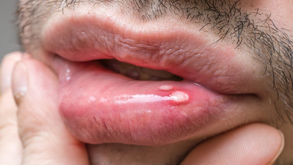 Signes du virus du papillome humain que vous devez connaître