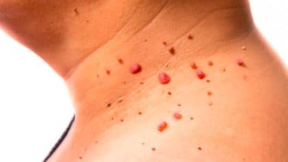 Signes du virus du papillome humain que vous devez connaître