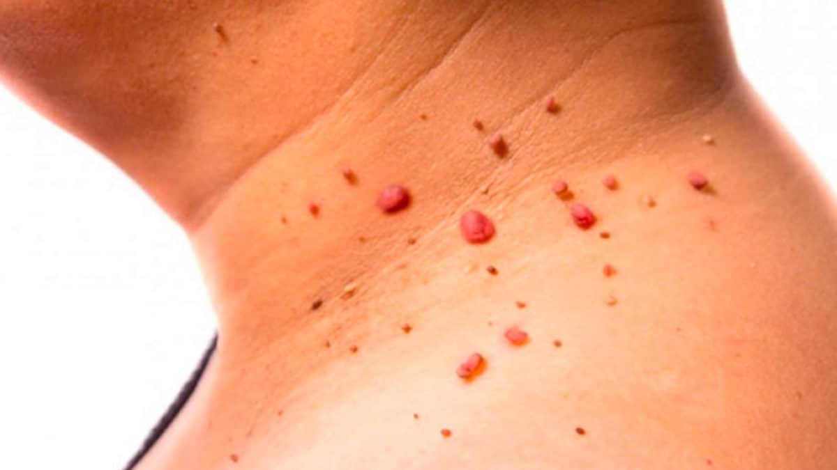 Signes du virus du papillome humain que vous devez connaître