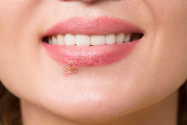 Syndrome de la bouche brûlante : c'est une maladie mystérieuse qui touche les personnes de plus de 40 ans