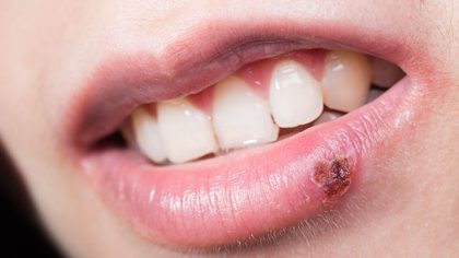 Syndrome de la bouche brûlante : c'est une maladie mystérieuse qui touche les personnes de plus de 40 ans