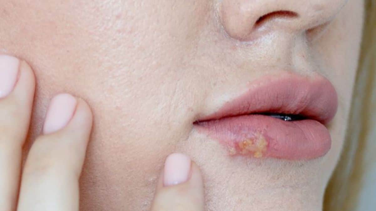 Syndrome de la bouche brûlante : c'est une maladie mystérieuse qui touche les personnes de plus de 40 ans
