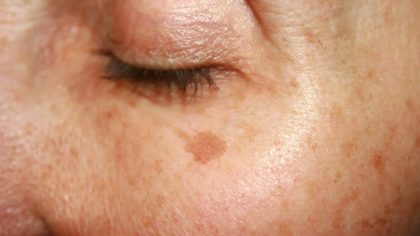 Taches brunes sur la peau : causes, prévention et traitement