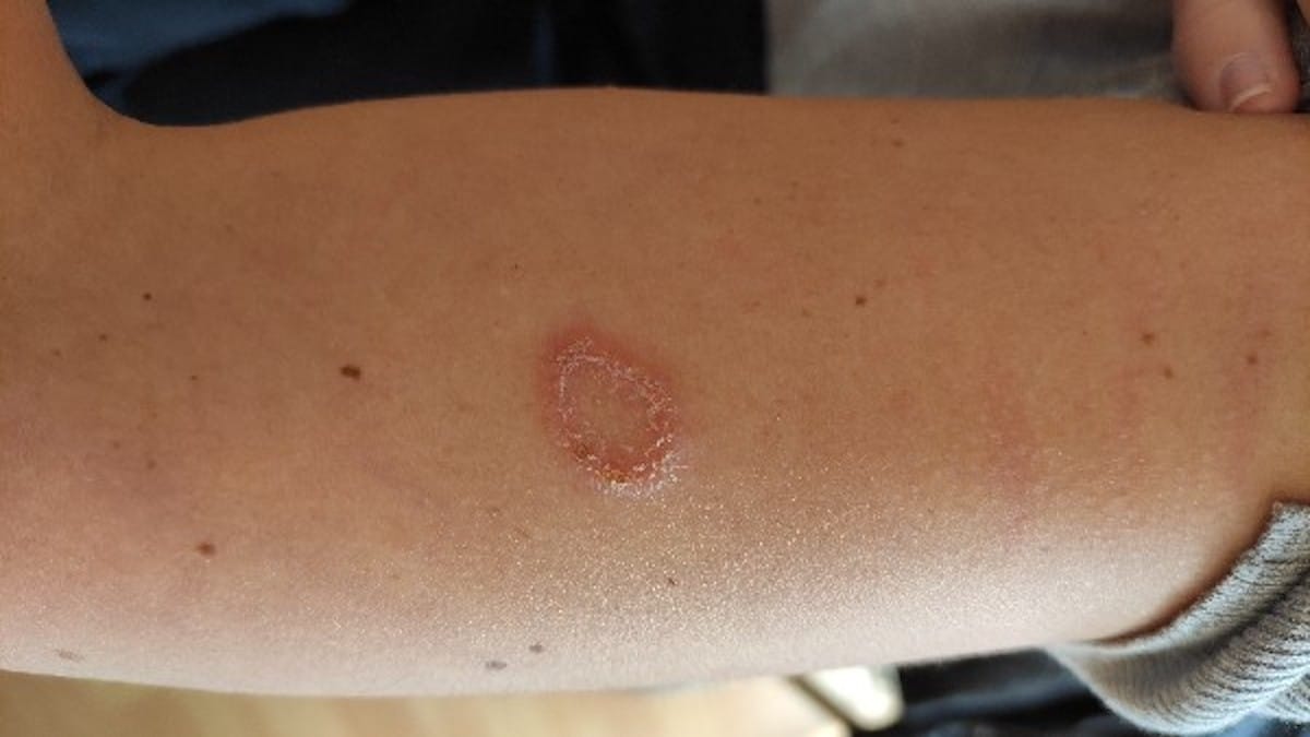 Teigne : causes, symptômes, traitements et comment l'identifier