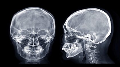 Un homme aux troubles de la colère s'effondre en larmes après la révélation du radiologue concernant son scanner cérébral