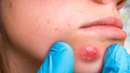 Abcès : types, symptômes, causes et traitement