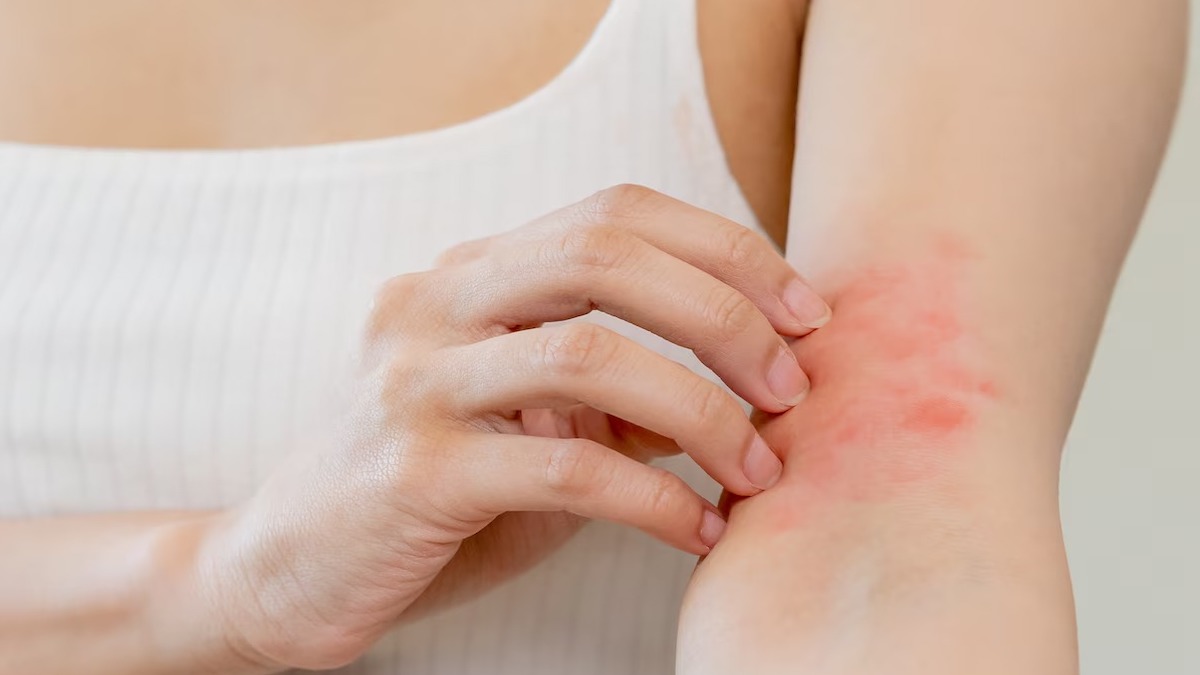 Urticaire de stress : pas toujours une allergie
