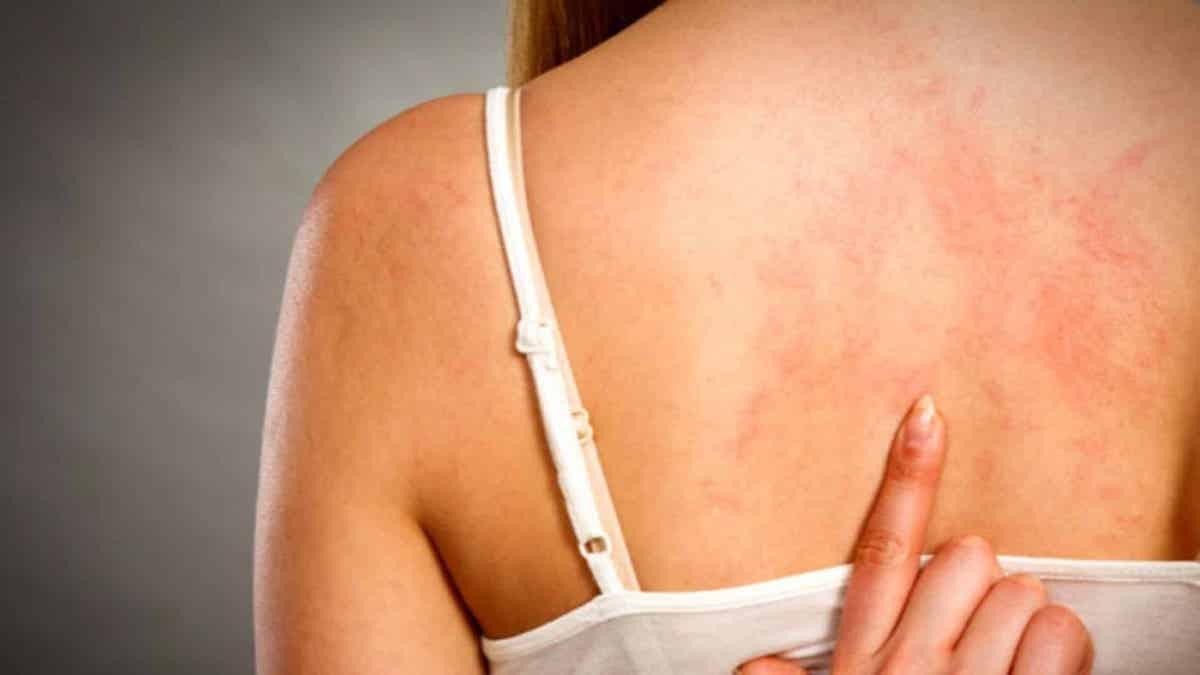 Urticaire de stress : pas toujours une allergie