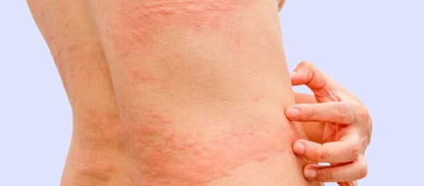 Urticaire de stress : pas toujours une allergie
