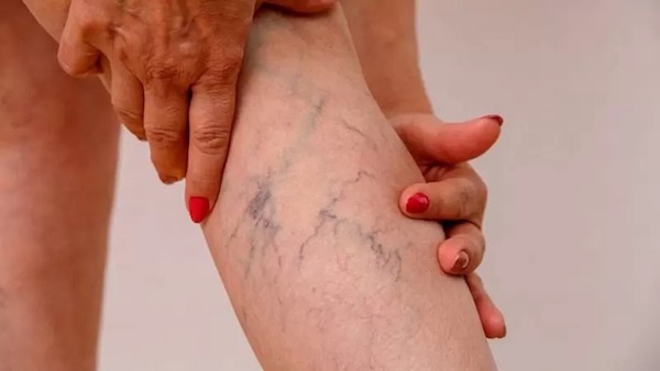 Varices : symptômes et causes