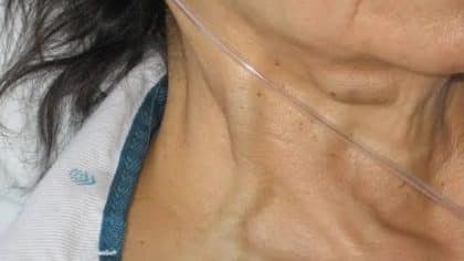 Veines jugulaires, distension - Symptômes et signes