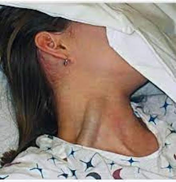 Veines jugulaires, distension - Symptômes et signes