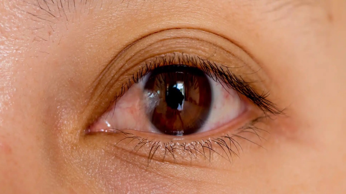 Yeux charnus (Ptérygion) : causes, symptômes et traitements
