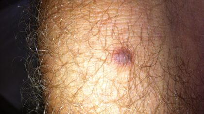 3 maladies de peau étranges que l'on confond avec des verrues