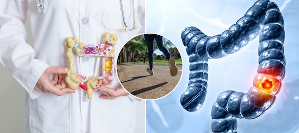 4 symptômes du cancer du côlon que vous ne devriez jamais ignorer