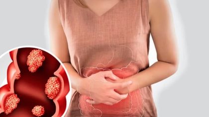 4 symptômes du cancer du côlon que vous ne devriez jamais ignorer