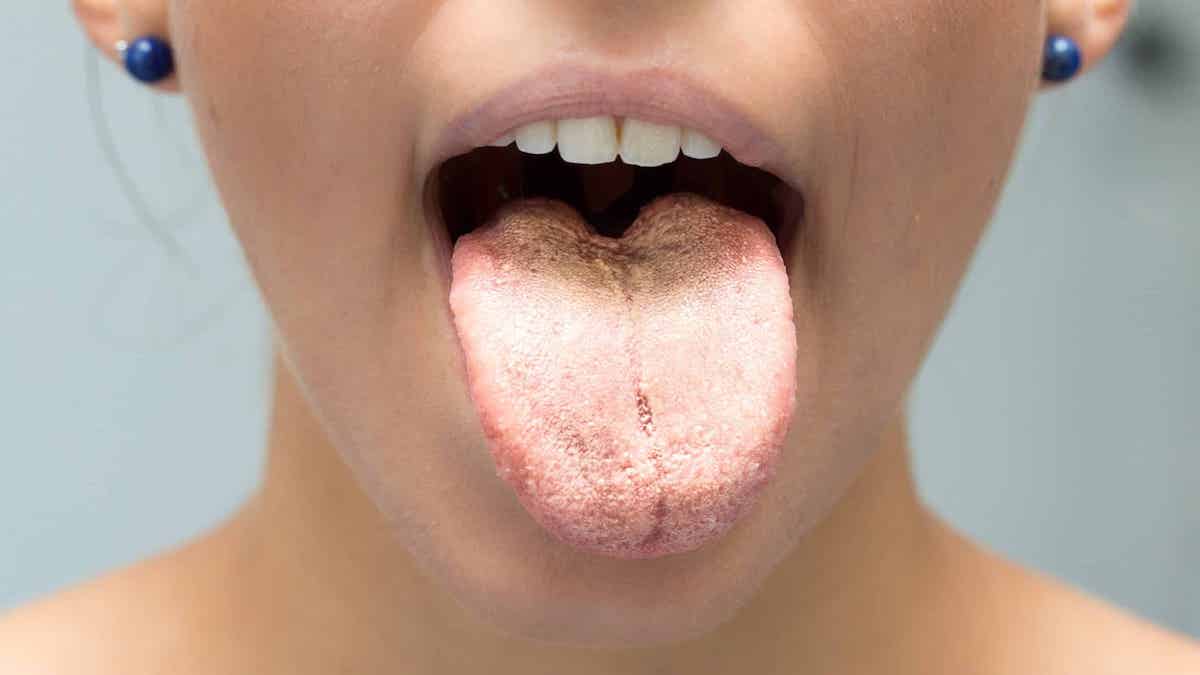 5 causes de la langue blanche