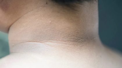 Acanthosis nigricans : symptômes et causes