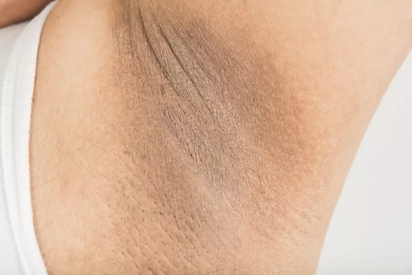 Acanthosis nigricans : symptômes et causes