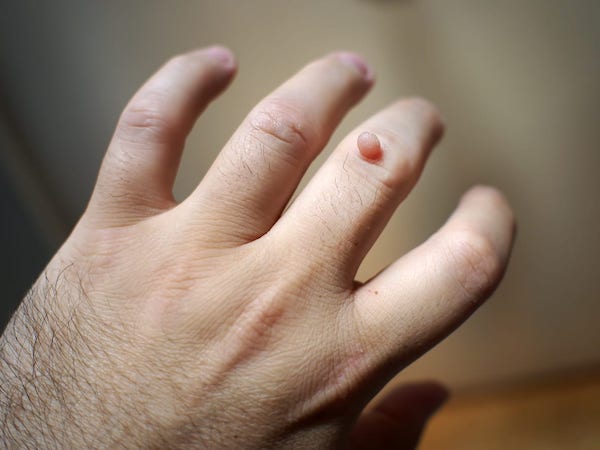 Acrochordons : causes, symptômes et traitements