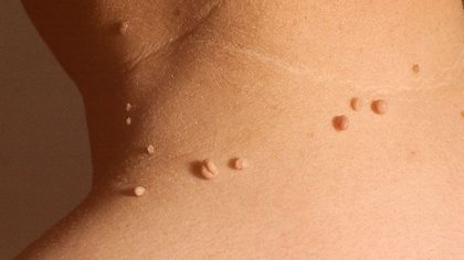 Acrochordons : causes, symptômes et traitements
