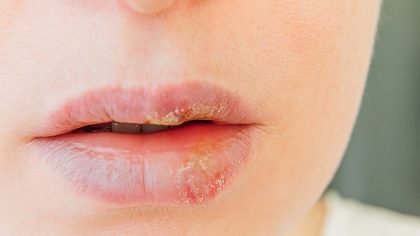 Boutons de fièvre : symptômes et causes