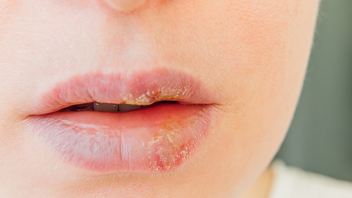 Boutons de fièvre : symptômes et causes