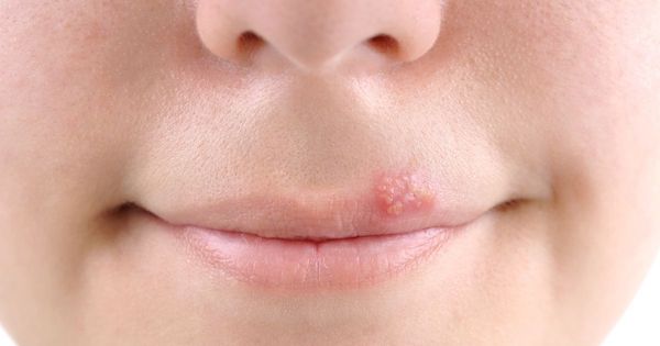 Boutons de fièvre : symptômes et causes