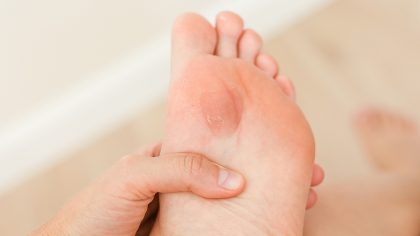 Éliminez les callosités naturellement avec ce remède maison efficace