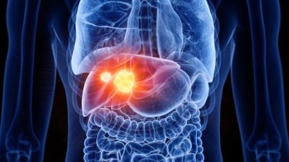Cette habitude quotidienne pourrait accélérer l’apparition du cancer du foie