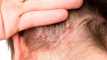 Comment reconnaître la teigne, l'infection derrière votre coupe de cheveux
