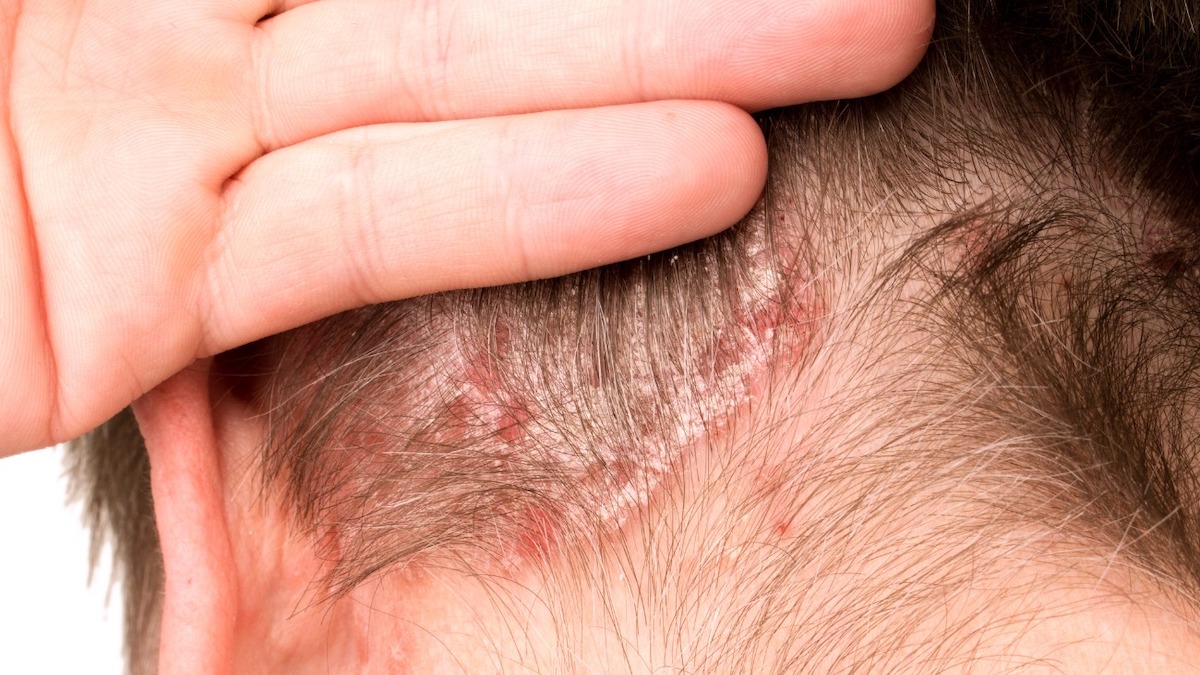 Comment reconnaître la teigne, l'infection derrière votre coupe de cheveux