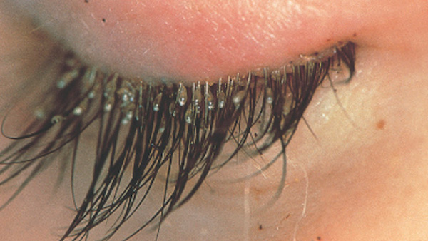 Demodex : les acariens qui vivent sur vos cils
