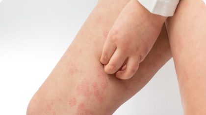 Dermatite de contact : symptômes et causes