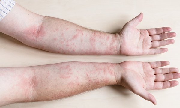 Dermatite de contact : symptômes et causes