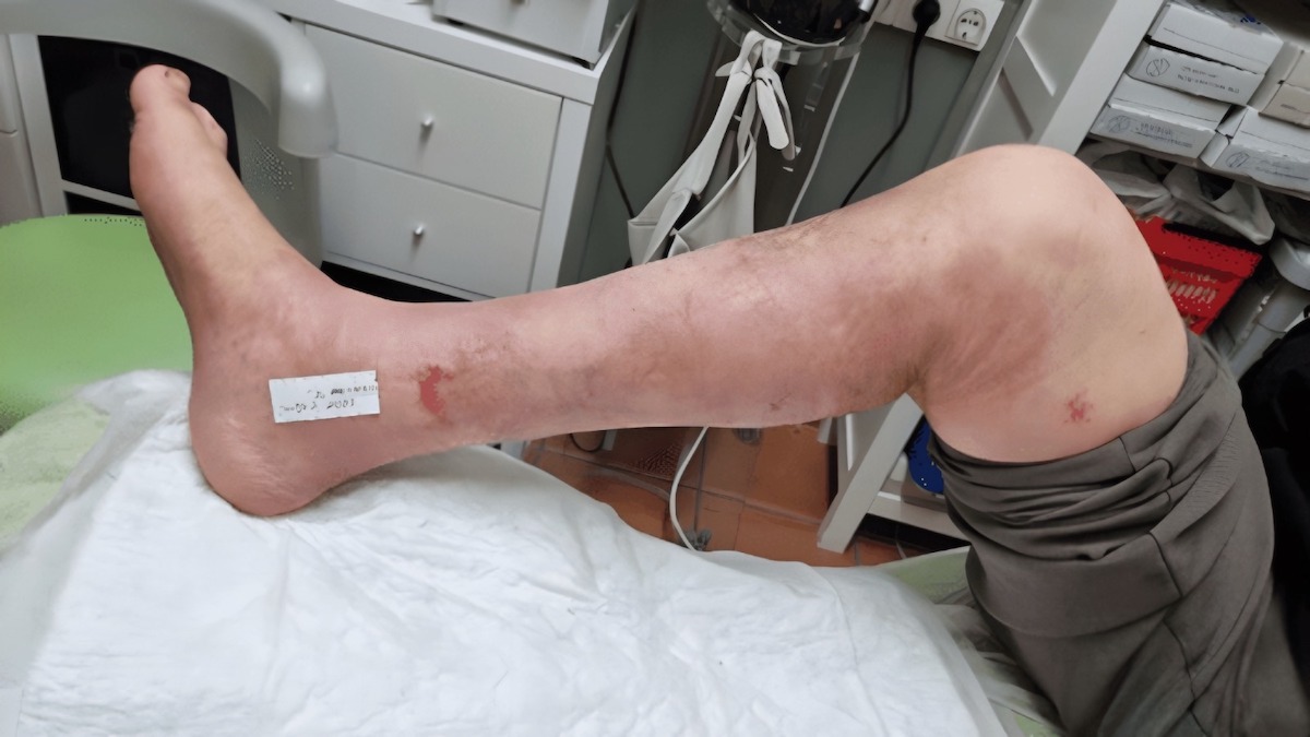 Dermatite et ulcères de stase