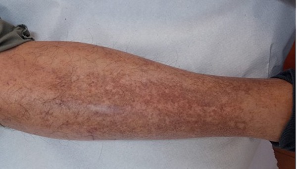 Dermatite et ulcères de stase