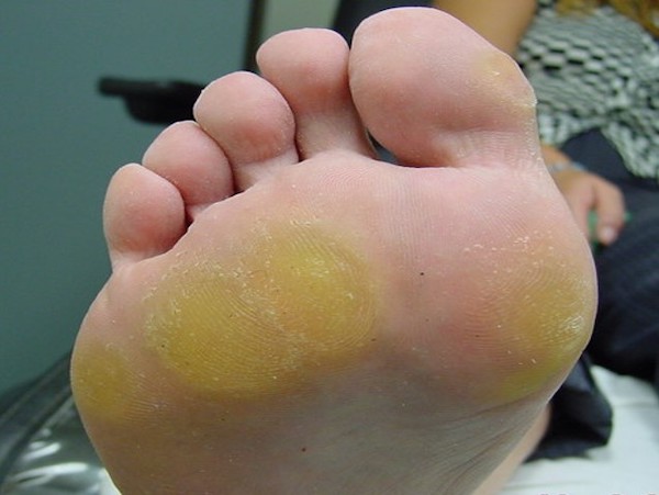 Dermatophytose : son impact sur la santé podiatrique