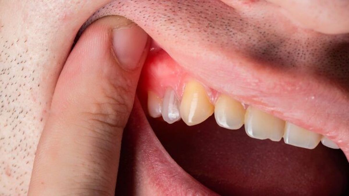 Kyste ou abcès périapical ? Symptômes, causes et traitement