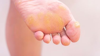 La puissante pommade à l'ail et à l'oignon pour éliminer les callosités des pieds