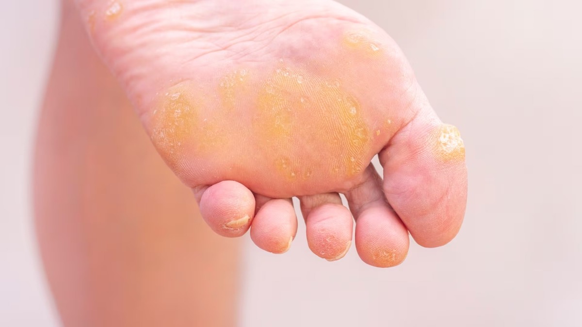 La puissante pommade à l'ail et à l'oignon pour éliminer les callosités des pieds
