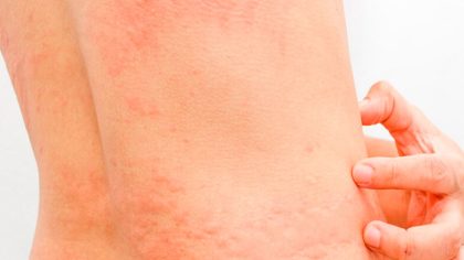Le cancer de la peau provoque-t-il des démangeaisons ?