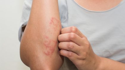 Le cancer de la peau provoque-t-il des démangeaisons ?